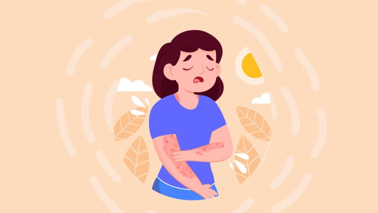 Huile CBD Psoriasis